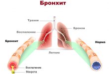 Photo of Лечение бронхита у взрослых