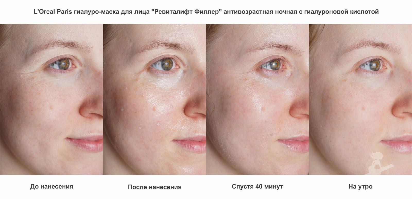 Фото 48 — Увлажнение и питание: гиалуроновая кислота