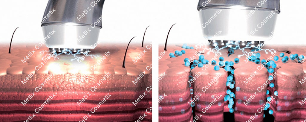 Фото 45 — Электропорация кожи