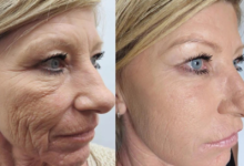 Photo of Лазерное омоложение кожи