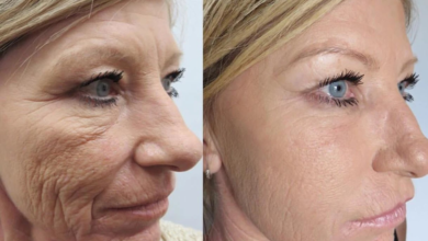 Photo of Лазерное омоложение кожи
