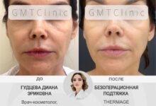 Photo of Радиочастотный лифтинг