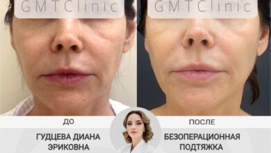 Photo of Радиочастотный лифтинг