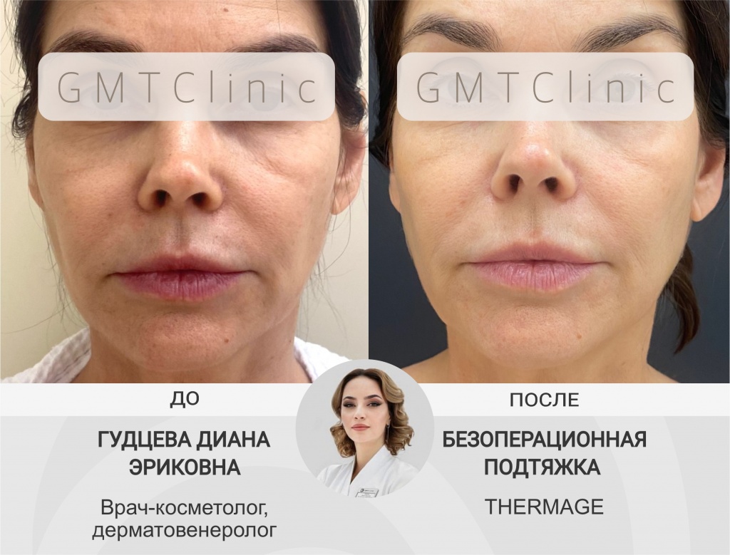 Фото 38 — Радиочастотный лифтинг