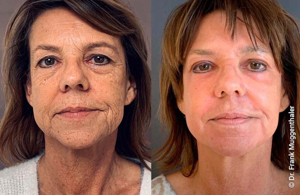 Фото 2 — Пилинг фруктовой кислотой