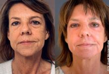 Photo of Пилинг фруктовой кислотой