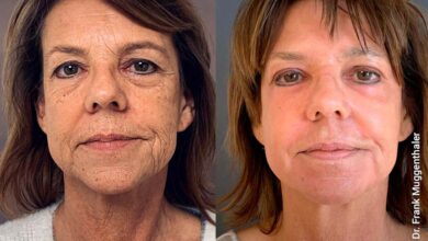 Photo of Пилинг фруктовой кислотой