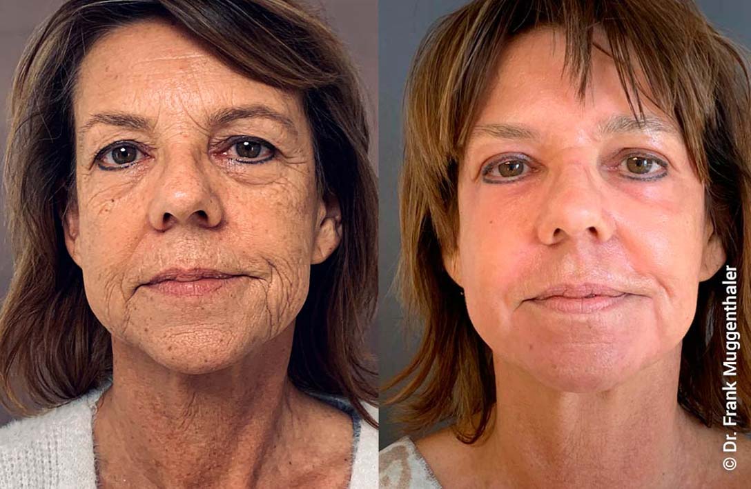 Фото 2 — Пилинг фруктовой кислотой