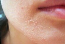 Photo of Проблема сухости кожи