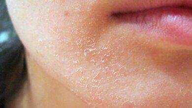 Photo of Проблема сухости кожи